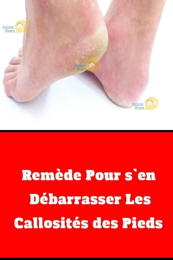 Des astuces naturelles pour enlever la corne des pieds